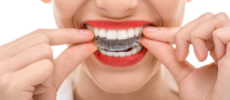 Closeup of a woman wearing red lipstick putting on clear aligner Invisalign trays to straighten her teeth