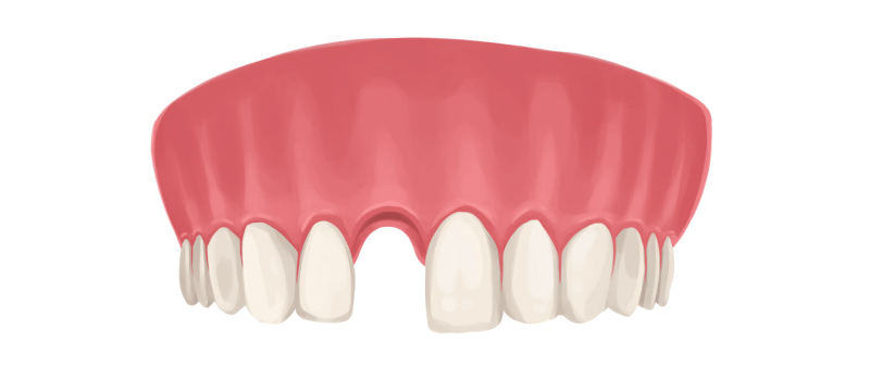 Drawing of the upper arch of teeth with a missing front tooth that needs a dental implant