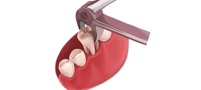 Drawing of a tooth being extracted by special dental pliers in Liberty, MO