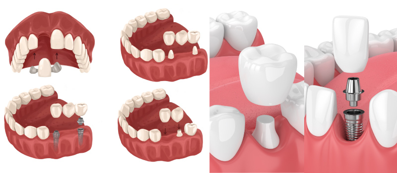 Bridge configurations next to a dental crown and a dental implant with a crown