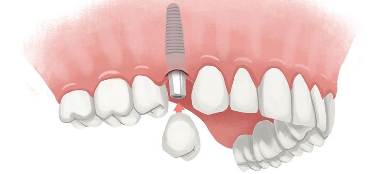 Illustration of upper gums with a single dental implant to replace a missing tooth