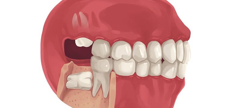 Illustration of an impacted wisdom teeth growing into a neighboring tooth