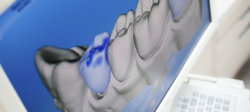 Digital impression taken of a patient's lower arch of teeth