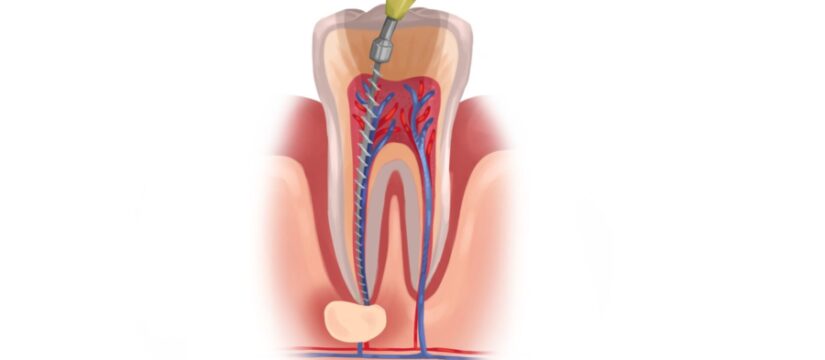 molar tooth getting root canal therapy to help with dental abscess